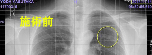 施術前の左上肺野のレントゲン
